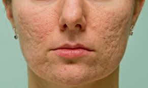 acne scarring treatment help removal