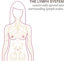 Lymph Node Removal Lymphedema National Breast Cancer