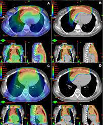 lower astinal lymphoma