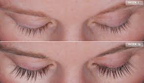 Learn how it works, potential side effects and the cost. Latisse Eyelash Growth Treatment New York City Long Island