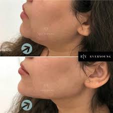 Free consultation with our aesthetic clinicians. Best Dermal Fillers In Vancouver Bc