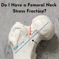 fem neck stress fracture