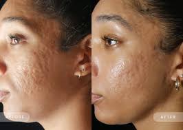 profractional laser treatment are you