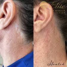camouflage facelift scars expert