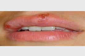 herpes simplex signs and symptoms dr
