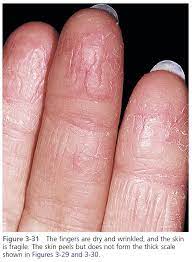eczema and hand dermais