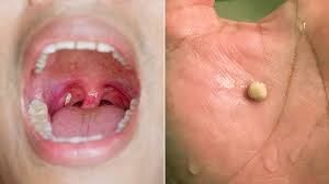 tonsil stones how to treat them ent