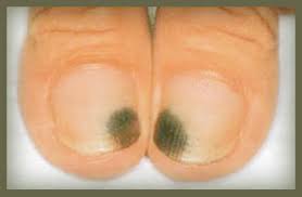 Nail fungus can cause the nail to become thick or ragged and appear yellow, green, brown or black. Black Toenail Fungus Black Toenail