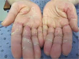 flagellate pattern of toxic erythema of