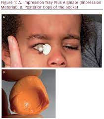 pediatric patient after enucleation