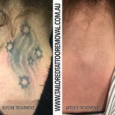 tailored tattoo removal
