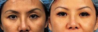 fat grafting upper eyelid surgery dr