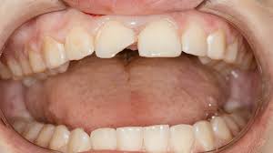 During a filling, your dentist fills these holes with a substance, such as amalgam or. Tooth Fillings Jefferson City Dentist Huntline Dental Group