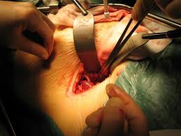 Image result for nephrology surgery
