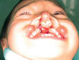cleft lip and cleft palate children