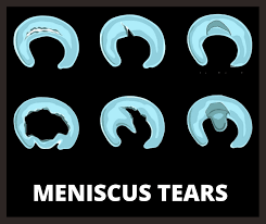 surgical repair of meniscus tears