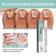 anti fungal nail treatment repair
