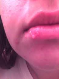 how to get rid of white ps on lips