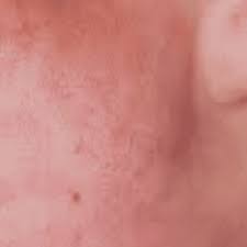 hiv skin rash images causes