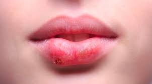 cold sores what are cold sores