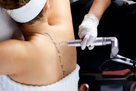 how tattoo removal works caviar feeling