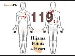 Hijama Points For Heart Disease Youtube