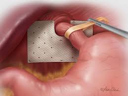 hiatal hernia repair by dr david w ford