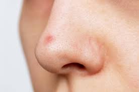 how to prevent pimples on nose