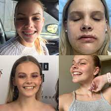 Braces progress!not the greatest before photos but i'm shocked at how much progress 21 days has brought! Five Years Braces Double Jaw Surgery Sinus Lift Bone Grafting And Dental Implants And I M Finally Done I Couldn T Be Happier Happy