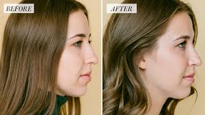 Size acceptance, body positivity, and fat activism are now part of the cultural lexicon, yet according to data f. My Rhinoplasty Procedure Story Nose Before And After Photos Allure