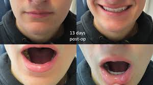 lower lip p mucocele verus mucus