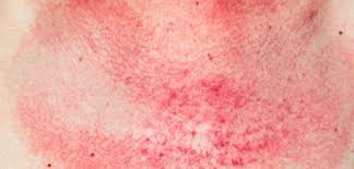 Image result for dermatomyositis images