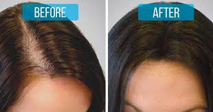 However, there are ways to combat it. Stop Hair Loss Add These Two Ingredients To Your Shampoo For An Affordable Hair Loss Treatment Hair Loss Treatment Natural Hair Loss Stop Hair Loss