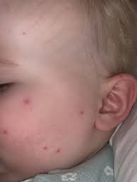 strange red spots on baby s face mumsnet