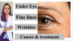 fine lines wrinkles under eye