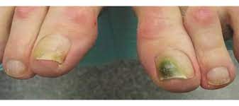 caratin rx green nail syndrome