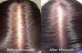 can rogaine minoxidil make hair loss