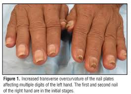 acquired pincer nail deformity