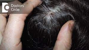 manage scabs on scalp with itching