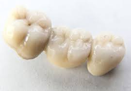 tooth under the dental bridge