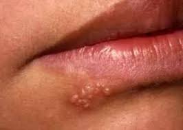 white ps on lips causes and