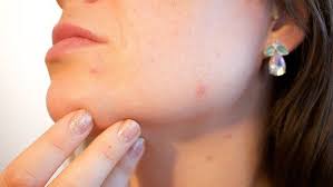 port du masque acné comment soigner