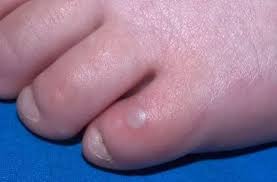 hand foot and mouth disease how to spot