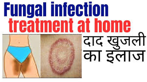 fungal infection treatment at home
