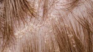 seborrheic dermais on scalp