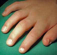nail patella syndrome causes symptoms