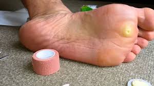 The substance has the property of destroying microorganisms, removing. Plantar Wart Removal Stages How To Get Rid Of Warts Fast With Surgery And Home Treatments