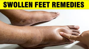 swollen feet edema remedy