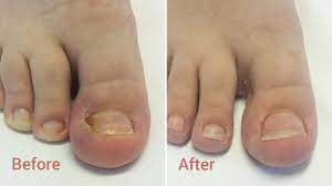 ingrown toe nail o driscoll s