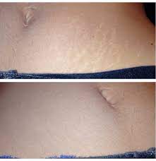 treat cover stretch marks with veil s